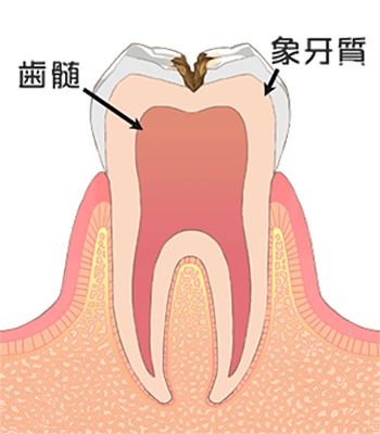 C2：象牙質のう蝕