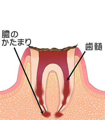 C4：歯冠部が崩壊し歯根まで達したう蝕