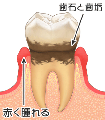 ３．軽度の歯周病